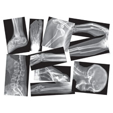 Roylco Broken Bones X-rays Set